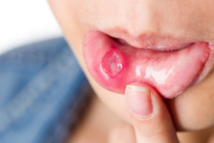 Nên ăn gì, kiêng gì khi bị nhiệt miệng để nhanh khỏi