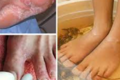Hướng dẫn 10+ mẹo trị nước ăn chân an toàn và hiệu quả nhanh tại nhà
