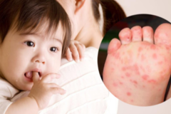 Mách mẹ mẹo chăm sóc trẻ bị bệnh tay chân miệng tại nhà