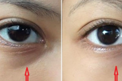 Tất tần tật mẹo đánh bay quầng thâm mắt cực đơn giản và an toàn