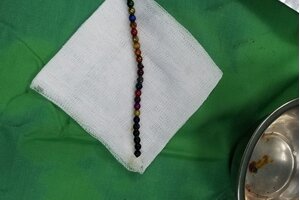 Nghệ An: Bé trai 3 tuổi bị thủng ruột vì nuốt 25 viên bi nam châm