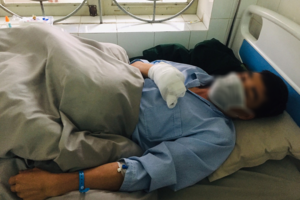 Người đàn ông dập nát bàn tay vì bình ga mini phát nổ