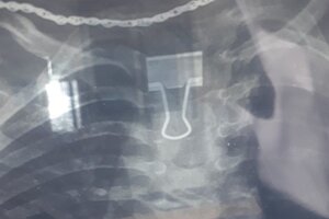 Lấy kẹp giấy mắc kẹt trong thực quản bé gái 2 tuổi