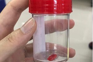 Cảnh báo dị vật đường thở ở trẻ em phụ huynh cần lưu ý