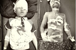 Mua pháo hoa trên mạng về đốt, 4 bé trai bị thương tích nặng