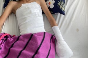 Bé trai bị pháo nổ gây đa chấn thương