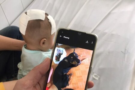 Bé gái 6 tháng tuổi bị chó cắn xuyên vào trong não
