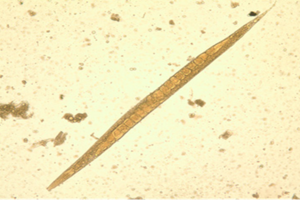 Bé 2 tuổi nhập viện vì bị viêm màng não do giun lươn