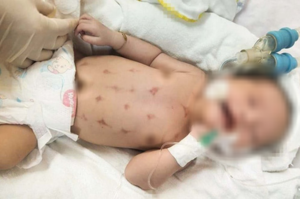 Bé 16 ngày tuổi nguy kịch vì gia đình xông than chữa đẹn