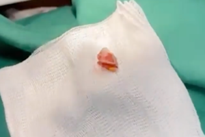 Nữ công nhân ho ra máu gần 2 năm vì vỏ kẹo rơi vào phế quản