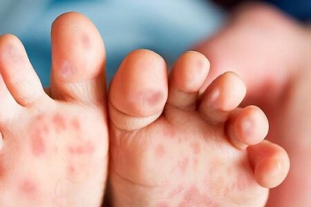 Virus gây tay chân miệng có thể tồn tại trong phân vài tháng