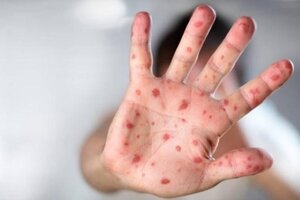 Số ca mắc tay chân miệng ở Hà Nội tăng gấp đôi