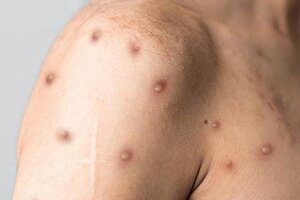 WHO sắp họp khẩn, xem xét đặt tên mới và nâng mức cảnh báo đối với bệnh đậu mùa khỉ