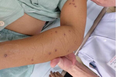 Cô gái trẻ ở Quảng Ninh bị ong vò vẽ đốt hơn 70 nốt