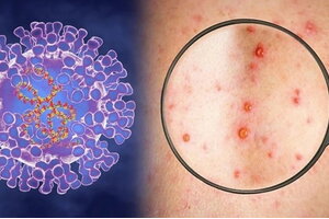 Bộ Y tế triển khai các giải pháp phòng chống bệnh đậu mùa khỉ