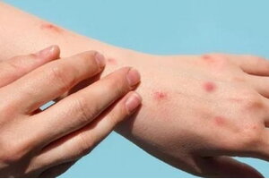 Đà Nẵng chuẩn bị 3 tình huống ứng phó với bệnh đậu mùa khỉ