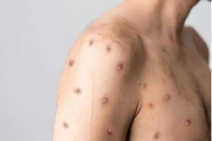 Hải Phòng tăng cường giám sát ngăn ngừa dịch bệnh đậu mùa khỉ