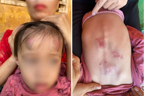 Vụ bé gái 2 tuổi bị bạn đánh dã man trong lớp: Tạm đình chỉ cơ sở trông giữ trẻ