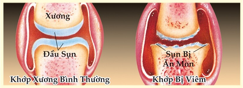 viêm khớp gối