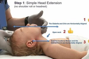 Từ vụ chiến sĩ Công an cứu bé gái bị đuối nước: Sơ cứu thế nào cho đúng cách?