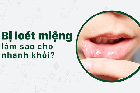 Bị loét miệng làm sao cho nhanh khỏi?