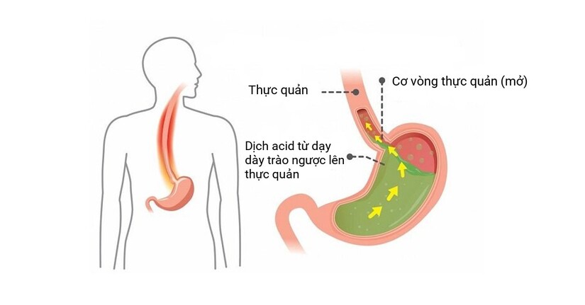 Trào ngược dạ dày có chữa được không