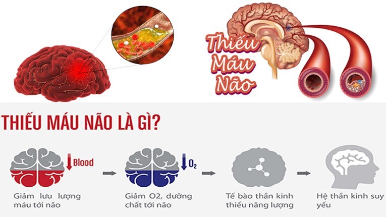 Thiếu máu não uống thuốc gì