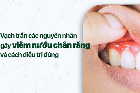 'Vạch trần' các nguyên nhân gây viêm nướu chân răng và cách điều trị