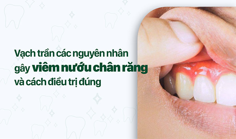 viêm nướu chân răng