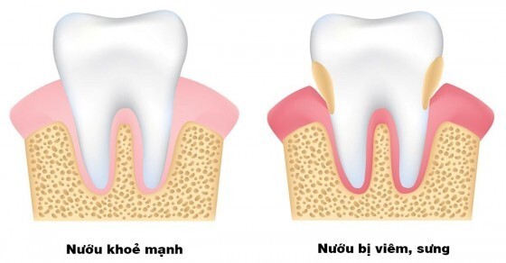 viêm nướu chân răng 