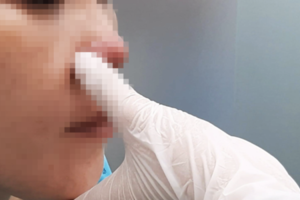 Cô gái trẻ phải nhập viện cấp cứu sau 3 ngày làm đẹp tại spa