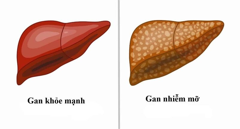 gan nhiễm mỡ nhẹ