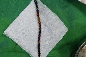 Bé trai 3 tuổi nuốt 25 viên bi nam châm đồ chơi vào bụng