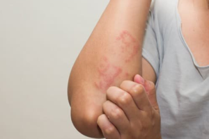 Dị ứng thực phẩm ngày Tết: Dấu hiệu nhận biết và cách xử trí