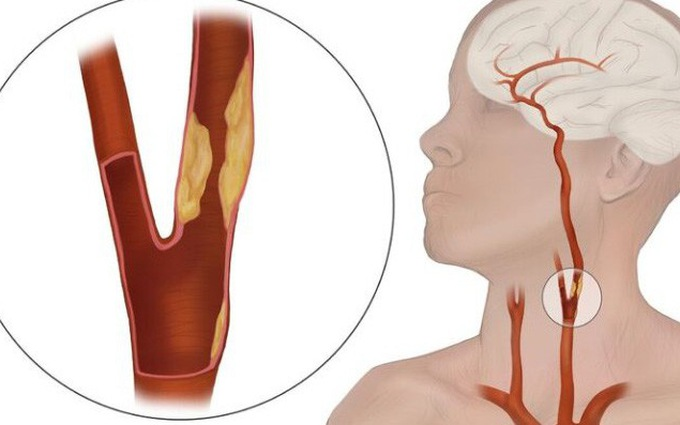 Thiếu máu não triệu chứng 