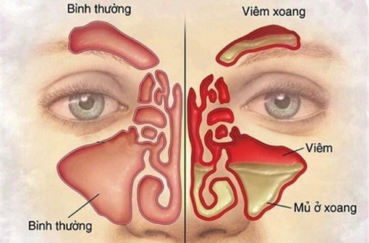 sổ mũi đau họng