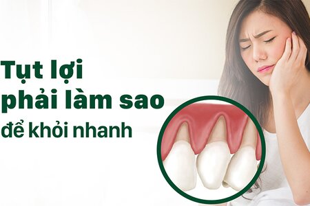 Làm gì để khỏi nhanh tụt lợi, bảo vệ răng miệng toàn diện?