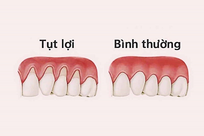 tụt lợi phải làm sao