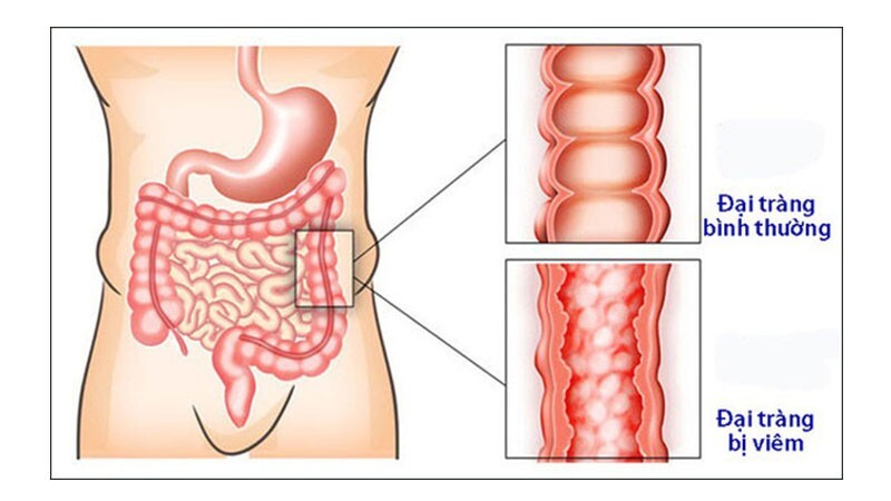 bụng sôi sùng sục