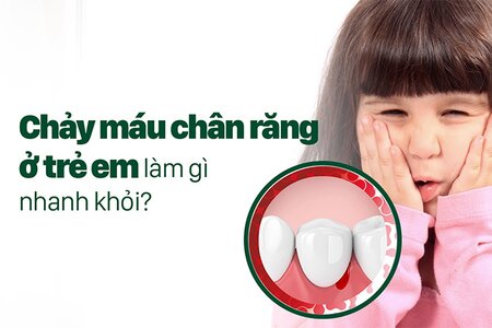 Chảy máu chân răng ở trẻ em làm gì nhanh khỏi?