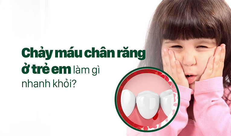 Chảy máu chân răng ở trẻ em