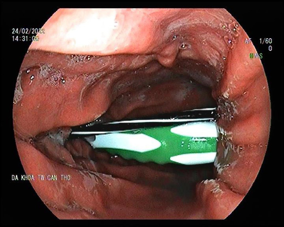 Bàn chải đánh răng, ruột bút bi trong dạ dày bệnh nhân 23 tuổi