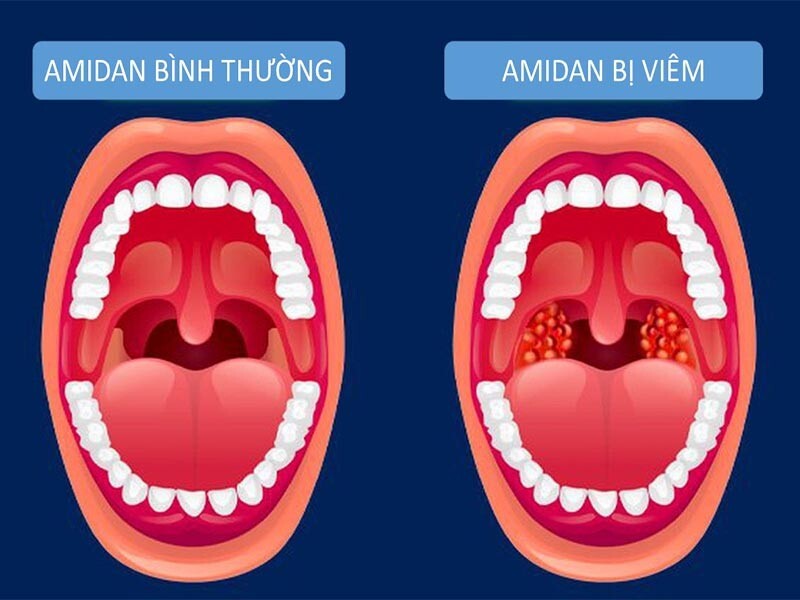 nuốt nước bọt đau