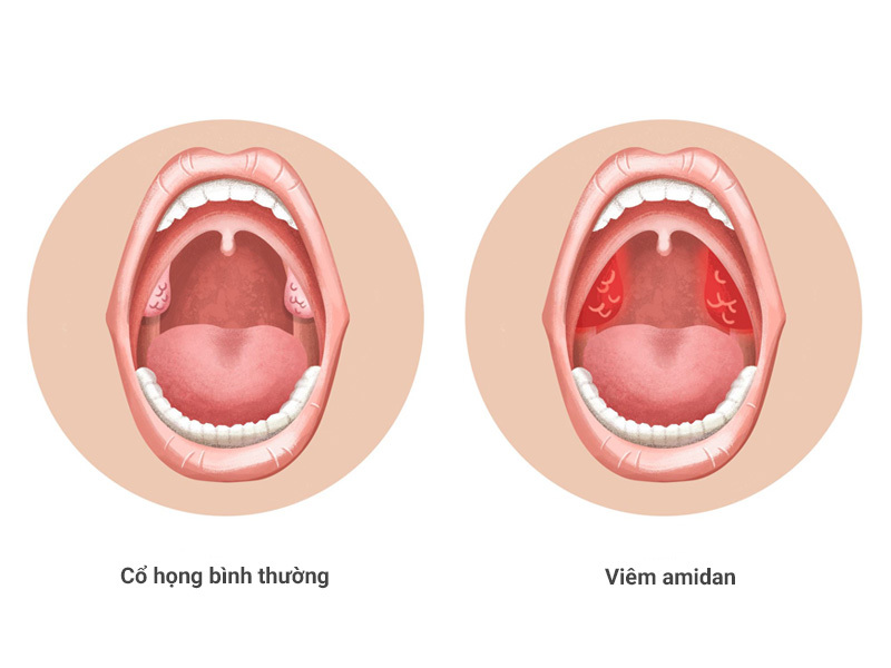 trẻ em viêm amidan sốt cao