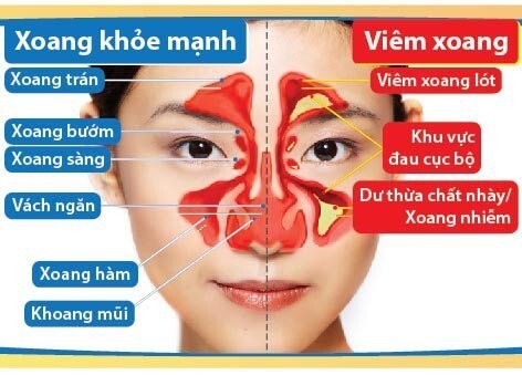 viêm mũi xoang đợt cấp