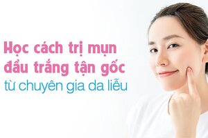 Học cách trị mụn đầu trắng tận gốc từ chuyên gia da liễu
