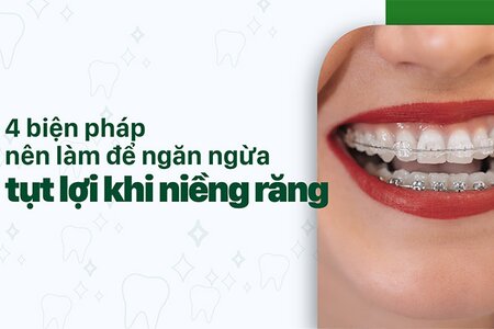 4 biện pháp nên làm để ngăn ngừa tụt lợi khi niềng răng 