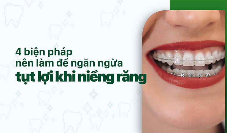 tụt lợi khi niềng răng