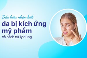 Dấu hiệu nhận biết da bị kích ứng mỹ phẩm và cách xử lý đúng