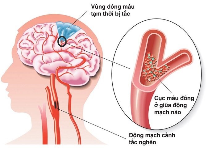 chóng mặt khi thay đổi tư thế